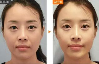 連明星也追捧的水光針,了解一下